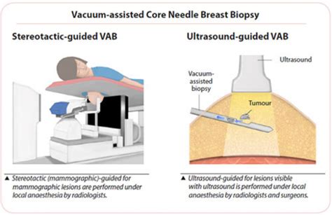 does a breast biopsy hurt.